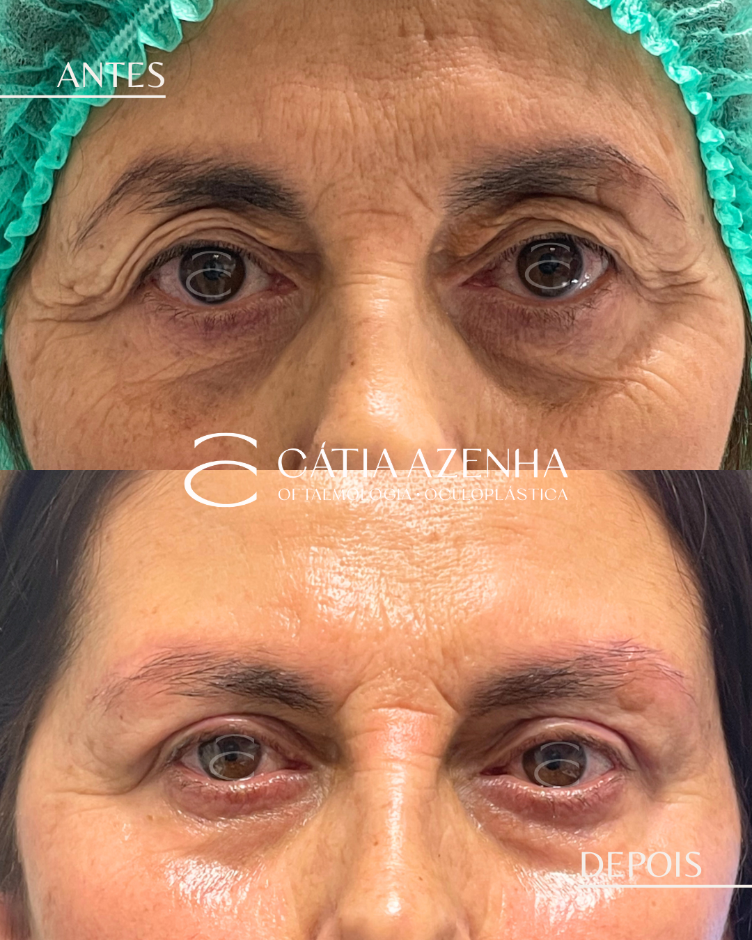 browlift e blefaro sup12