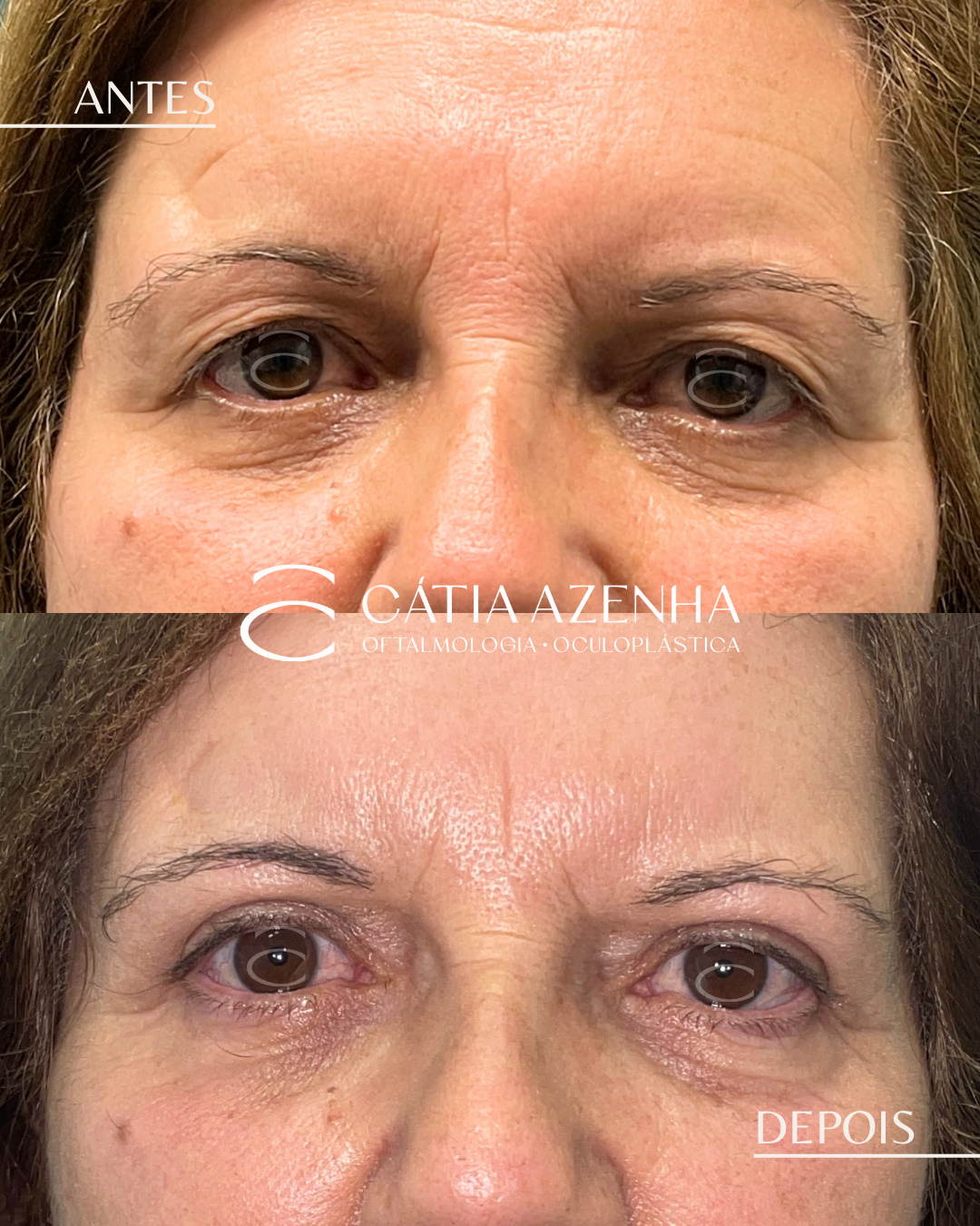 browlift+blefaro sup AD2