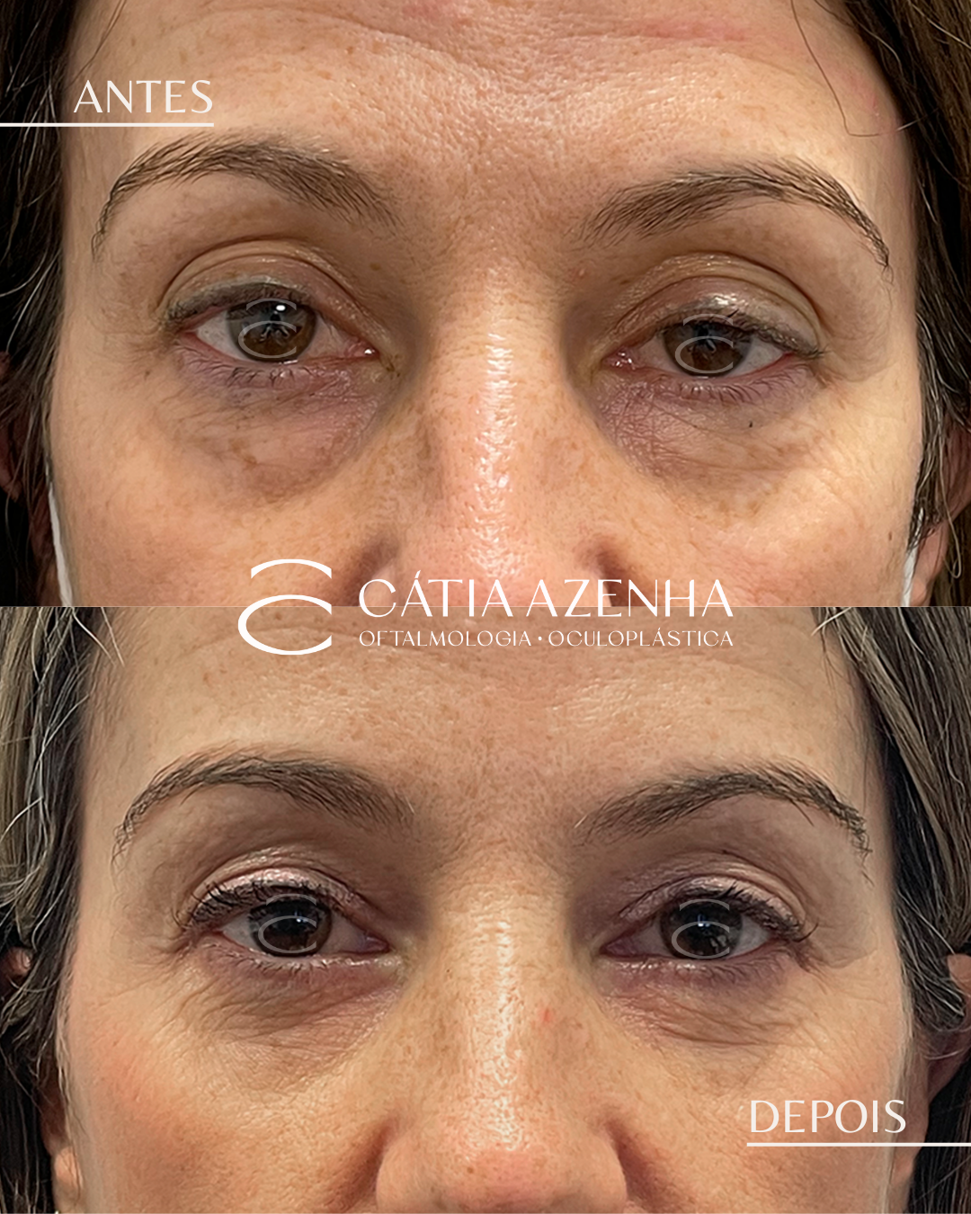 ptose e blefaro inf transconj 1
